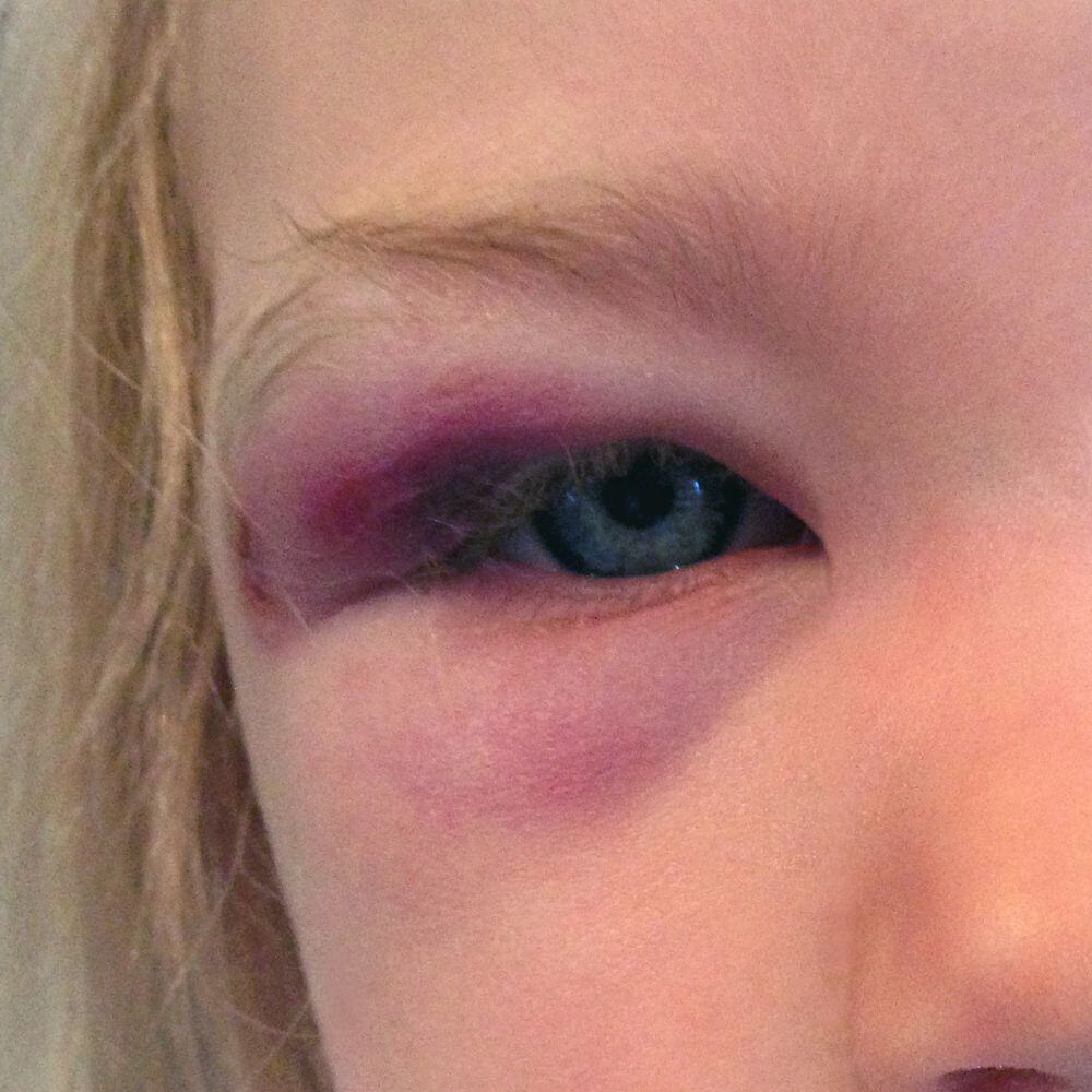 Prevención de Accidentes Oculares en Alinea Visión