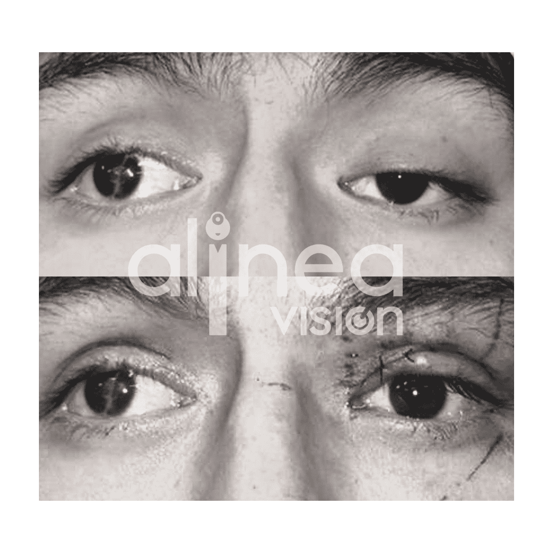 ¿Conoces sobre la Ptosis?